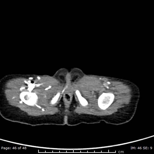 File:Neuroblastoma (Radiopaedia 41472-44355 A 46).jpg