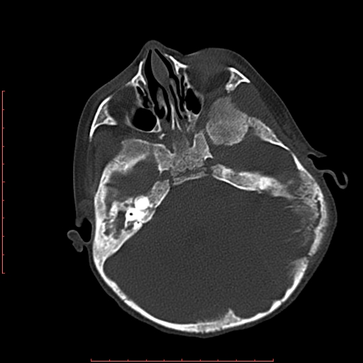 File:Neuroblastoma skull metastasis (Radiopaedia 56053-62683 Axial bone window 8).jpg