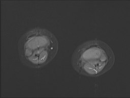 File:Neuroblastoma with bone metastases (Radiopaedia 67080-76414 Axial STIR 2).jpg