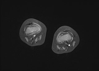 File:Neuroblastoma with bone metastases (Radiopaedia 67080-76414 Axial T1 C+ fat sat 11).jpg