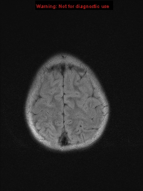 File:Neurofibromatosis type 1 with optic nerve glioma (Radiopaedia 16288-15965 Axial FLAIR 4).jpg