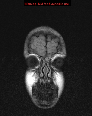 File:Neurofibromatosis type 1 with optic nerve glioma (Radiopaedia 16288-15965 Coronal FLAIR 24).jpg