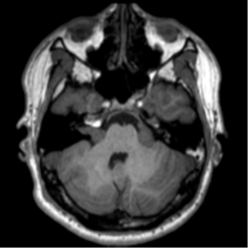 File:Neurofibromatosis type 2 (Radiopaedia 44936-48838 Axial T1 31).png