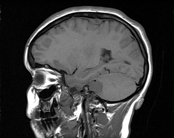 File:Neurofibromatosis type 2 (Radiopaedia 66211-75401 Sagittal T1 17).jpg