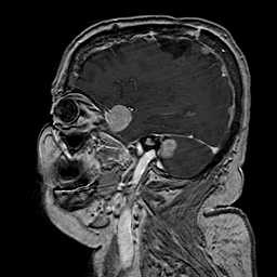 File:Neurofibromatosis type 2 (Radiopaedia 8713-9518 Sagittal T1 C+ 15).jpg
