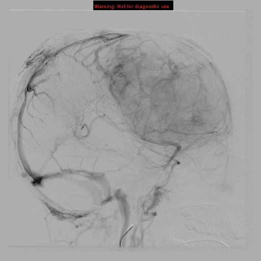 File:Neurofibromatosis type 2 (Radiopaedia 8953-9733 B 8).jpg