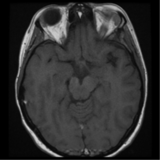 File:Neurofibromatosis type 2 - bilateral acoustic neuromata (Radiopaedia 40060-42566 Axial T1 13).png