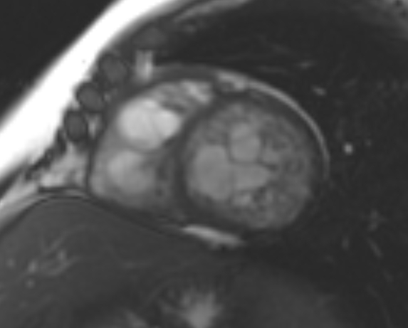 File:Non-compaction of the left ventricle (Radiopaedia 69436-79314 Short axis cine 119).jpg