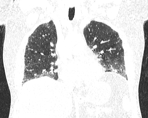 Non-specific interstitial pneumonia (NSIP) (Radiopaedia 68599-78228 Coronal lung window 41).jpg