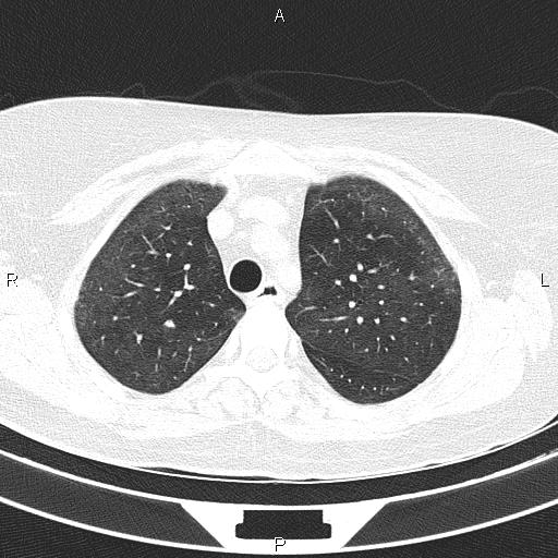 Non-specific interstitial pneumonia (Radiopaedia 83185-97567 Axial lung window 20).jpg