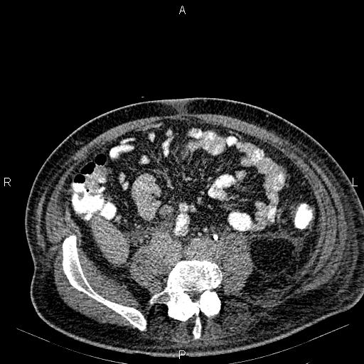 Non Hodgkin lymphoma in a patient with ankylosing spondylitis (Radiopaedia 84323-99621 Axial C+ delayed 49).jpg