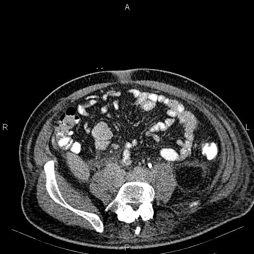 Non Hodgkin lymphoma in a patient with ankylosing spondylitis (Radiopaedia 84323-99621 Axial C+ delayed 50).jpg