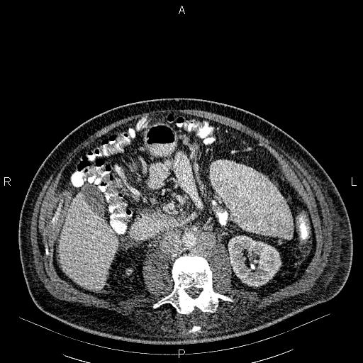 File:Non Hodgkin lymphoma in a patient with ankylosing spondylitis (Radiopaedia 84323-99621 B 41).jpg