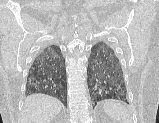 Non specific interstitial pneumonia (NSIP) (Radiopaedia 89725-106798 Coronal lung window 60).jpg