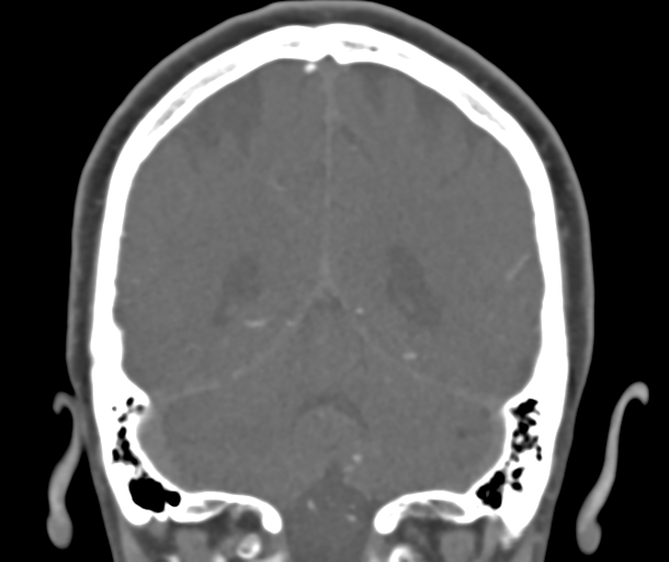 File:Normal CTA head (Radiopaedia 40801-43464 B 69).png