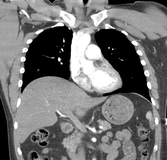 File:Normal CTA thorax (non ECG gated) (Radiopaedia 41750-44704 B 41).png