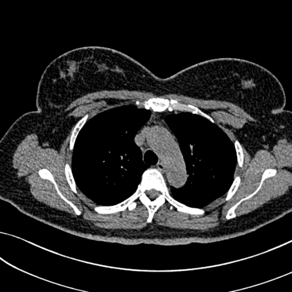 Normal CT chest- adult female (Radiopaedia 52522-58428 Axial non-contrast 41).jpg