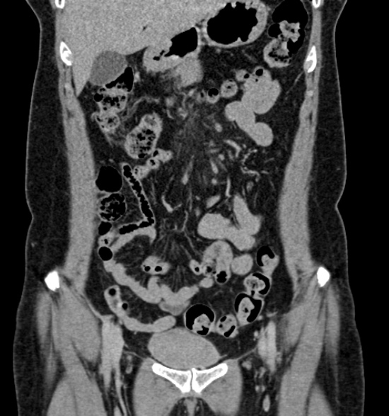 Normal CT intravenous urogram (Radiopaedia 39444-41759 A 215).jpg