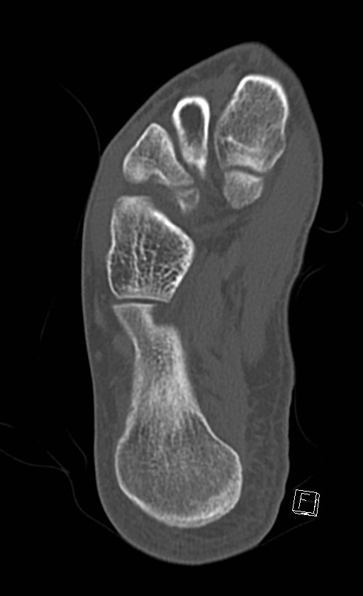 Normal CT of the ankle (Radiopaedia 47111-51658 Axial bone window 80).jpg