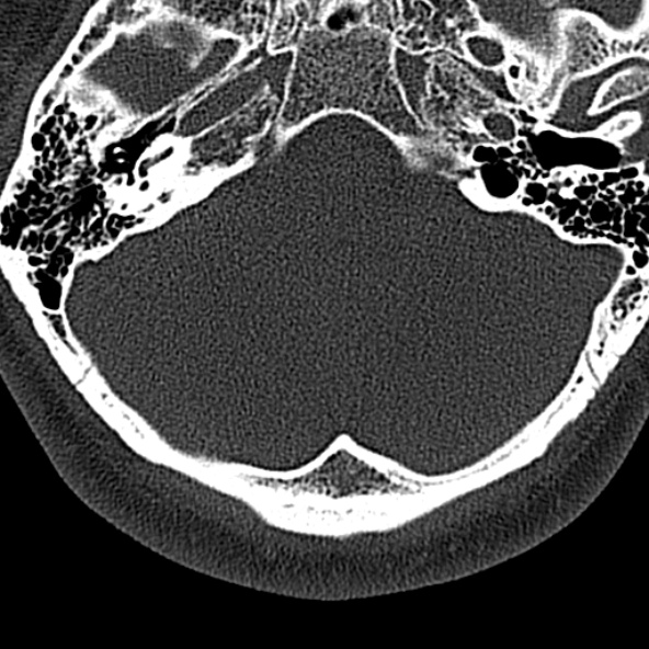 Normal CT of the cervical spine (Radiopaedia 53322-59305 Axial bone window 11).jpg
