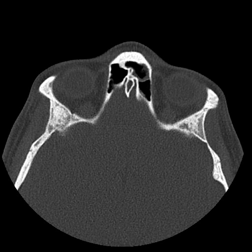 Normal CT paranasal sinuses (Radiopaedia 42286-45390 Axial bone window 35).jpg