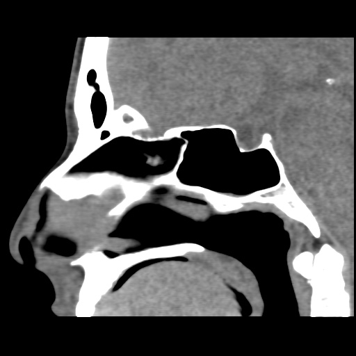 Normal CT paranasal sinuses (Radiopaedia 42286-45390 F 76).jpg