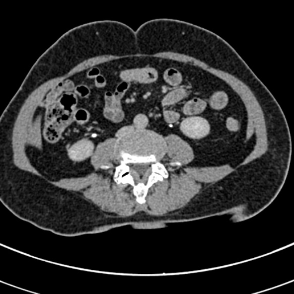 File:Normal CT split bolus study of the renal tract (Radiopaedia 48631-53634 Axial split bolus 152).jpg