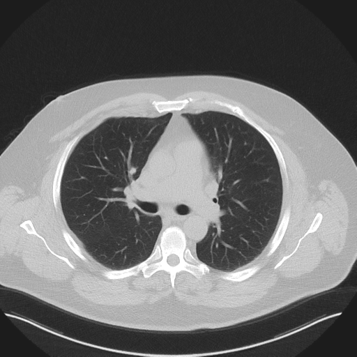 Normal HRCT (Radiopaedia 40797-43458 Axial lung window 25).png