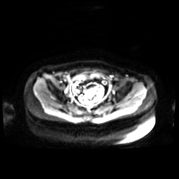 Normal MRI abdomen in pregnancy (Radiopaedia 88001-104541 Axial DWI 6).jpg
