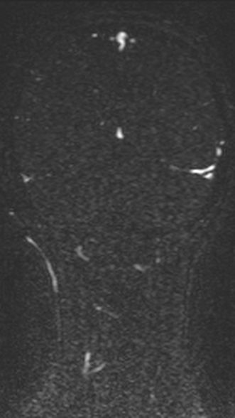Normal MRI brain with MRV- teenager (Radiopaedia 49425-54553 Coronal MRV 184).jpg