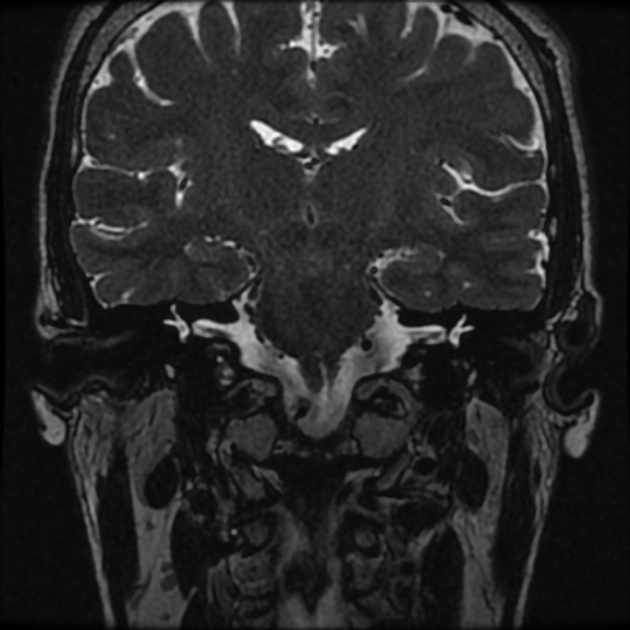 Normal MRI petrous (Radiopaedia 91317-108949 Coronal T2 49).jpg