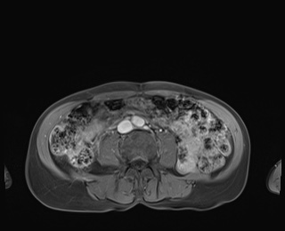 Normal adrenal glands MRI (Radiopaedia 82017-96004 M 64).jpg