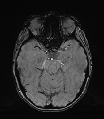 Normal brain MRI (TLE protocol) (Radiopaedia 40748-43405 Axial SWI 32).png