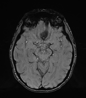 Normal brain MRI (TLE protocol) (Radiopaedia 40748-43405 Axial SWI 37).png