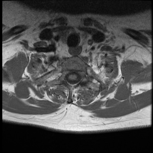File:Normal cervical and thoracic spine MRI (Radiopaedia 35630-37156 Axial T1 6).png