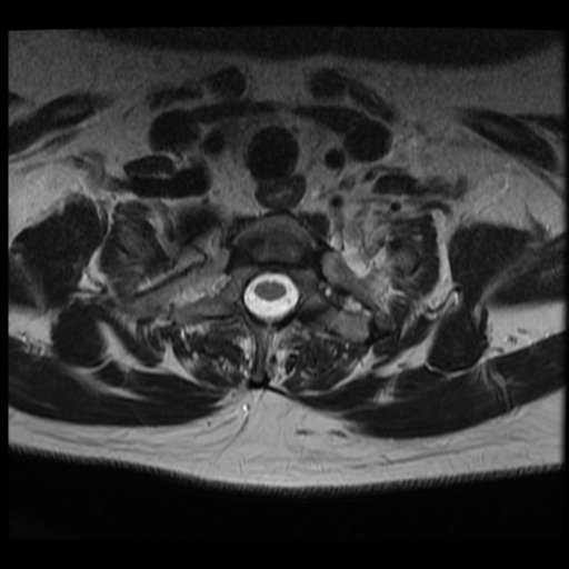 File:Normal cervical and thoracic spine MRI (Radiopaedia 35630-37156 Axial T2 6).png