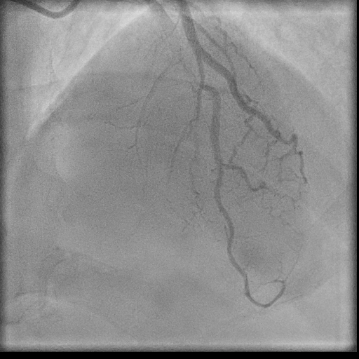 Normal coronary angiogram (DSA) (Radiopaedia 63081-71571 E 72).jpg