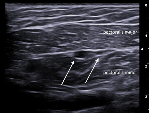 File:Normal interpectoral nodes (ultrasound) (Radiopaedia 86877-103081 A 1).png
