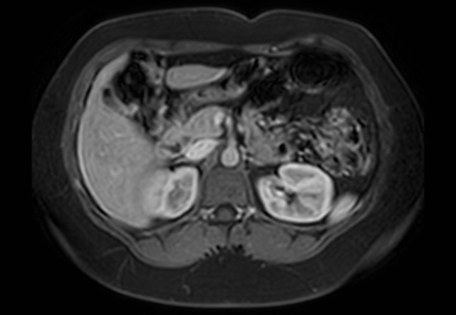 Normal liver MRI with Gadolinium (Radiopaedia 58913-66163 J 33).jpg