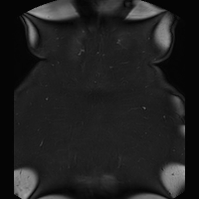 Normal liver MRI with Gadolinium (Radiopaedia 58913-66163 P 89).jpg