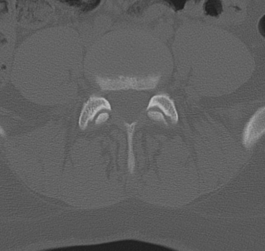 File:Normal lumbar spine CT (Radiopaedia 46533-50986 Axial bone window 55).png
