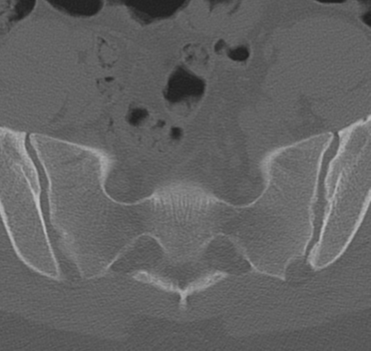 File:Normal lumbar spine CT (Radiopaedia 46533-50986 Axial bone window 75).png