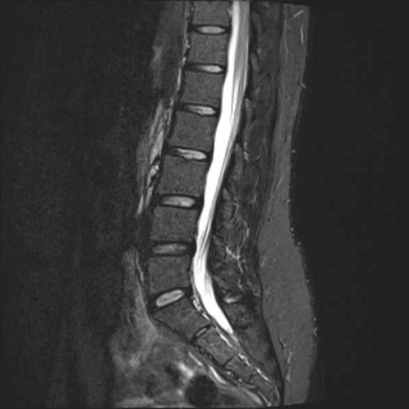 File:Normal lumbar spine MRI- 3 T (Radiopaedia 53280-59250 Sagittal STIR 12).jpg