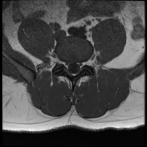 File:Normal lumbar spine MRI (Radiopaedia 35543-37039 Axial T1 13).png