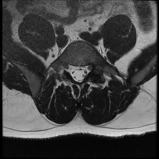 File:Normal lumbar spine MRI (Radiopaedia 35543-37039 Axial T2 10).png