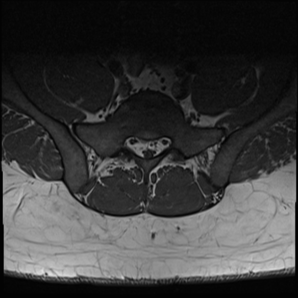 File:Normal lumbar spine MRI (Radiopaedia 47857-52609 Axial T1 30).jpg