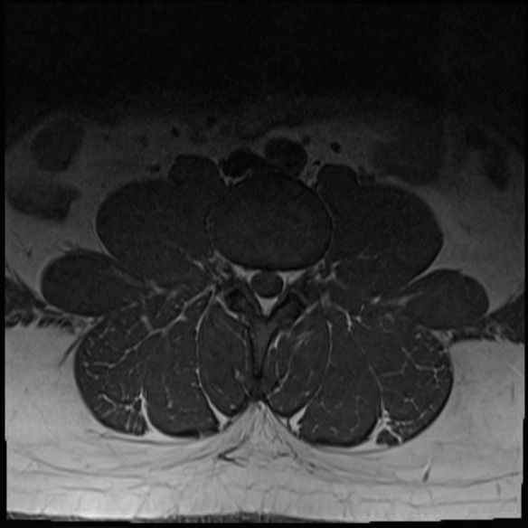 File:Normal lumbar spine MRI (Radiopaedia 47857-52609 Axial T1 7).jpg
