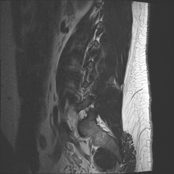 File:Normal lumbar spine MRI (Radiopaedia 47857-52609 Sagittal T2 18).jpg