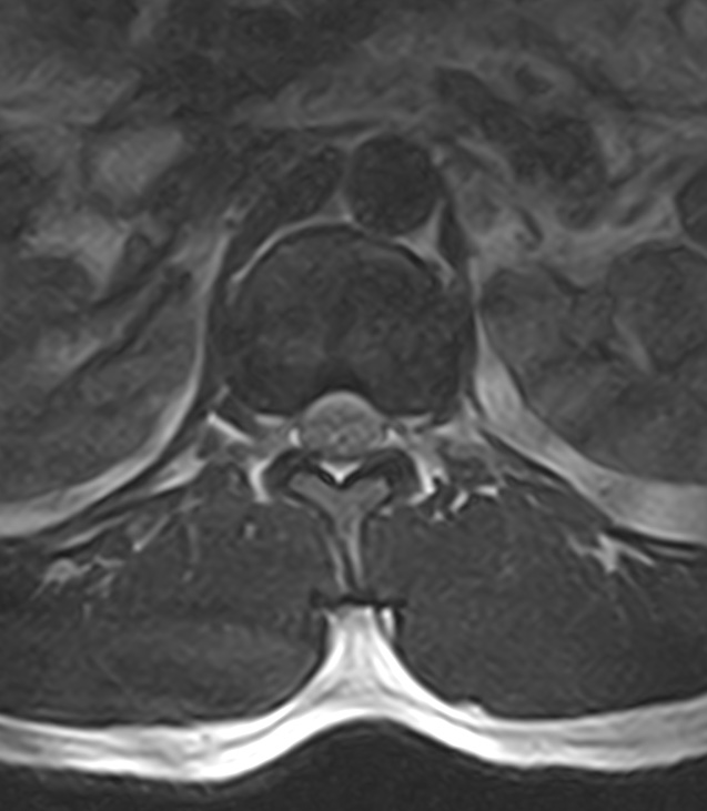 Normal lumbar spine MRI - low-field MRI scanner (Radiopaedia 40976-43699 Axial T2 19).jpg