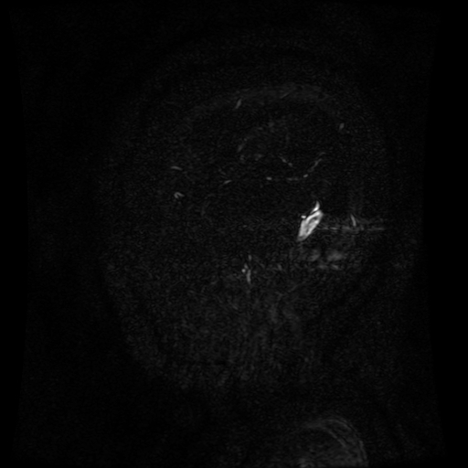 Normal noncontrast MR venography (Radiopaedia 87578-103957 A 14).jpg